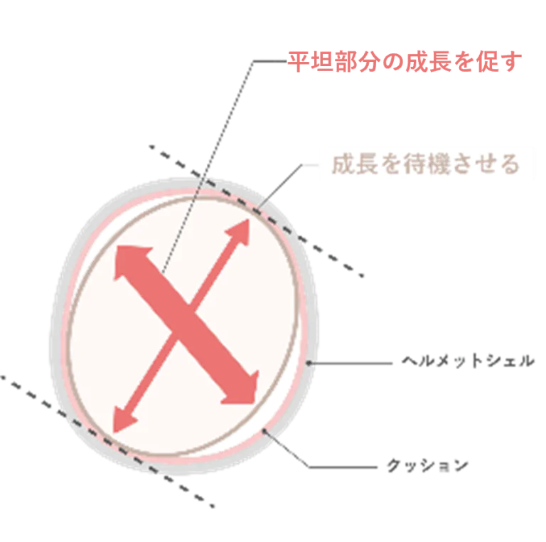 矯正ヘルメット治療